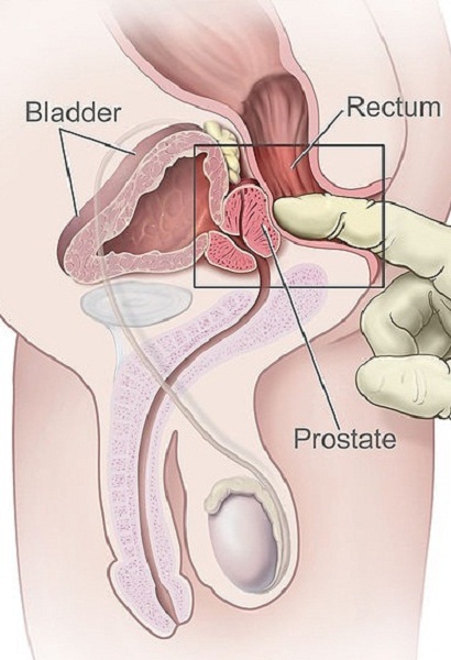 develop prostate problems