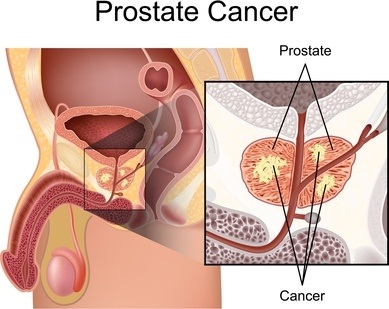 prostate cancer affects sex
